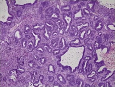 Figure 17.7, Non-atypical hyperplasia with randomly interspersed cystic and tubular glands. The entire endometrial compartment is involved, but local remodeling of glands with stroma creates regional heterogeneity of gland density. Glands are tubular, cystic, and branching.