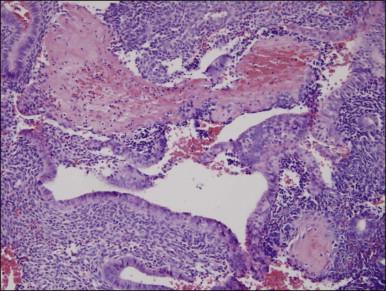 Figure 17.9, Fibrin thrombi can be seen in superficial blood vessels of non-atypical hyperplasia, causing local breakdown.