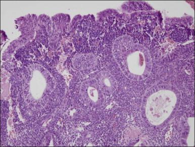 Figure 17.10, Stromal breakdown in non-atypical hyperplasia alters the cytology of the adjacent epithelium, and may lead to gland displacement.