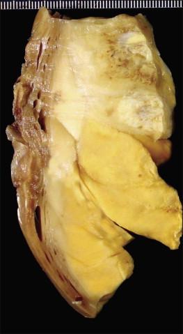 Figure 20.1, Endometrial stromal nodule. The tumor is well circumscribed from the adjacent myometrium and it has a tan to yellow cut surface with focal areas of necrosis and hemorrhage.