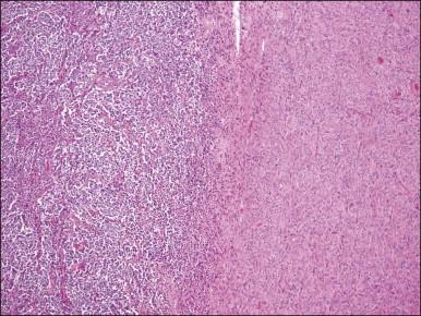 Figure 20.12, t(10;17) high-grade endometrial stromal sarcoma. Tumor cells with an epithelioid morphology (left) are juxtaposed to areas of endometrial stromal neoplasia with a fibroblastic appearance.