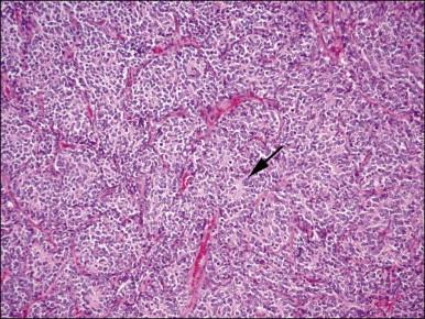 Figure 20.13, t(10;17) high-grade endometrial stromal sarcoma. The epithelioid areas are composed of cells with high-grade cytologic features and brisk mitotic activity. Pseudorosettes may be seen (arrow).