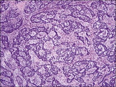 Figure 20.14, Low-grade endometrial stromal sarcoma with sex cord-like elements. Inter-anastomosing cords and trabeculae of ‘epithelial-like’ cells with architecture reminiscent of that of a granulosa cell tumor of the ovary are present in a background of neoplastic endometrial stromal cells.