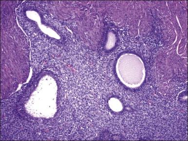 Figure 20.15, Low-grade endometrial stromal sarcoma with müllerian glandular elements. Benign endometrioid-type glands, with a slightly proliferative appearance, are present in an island of tumor.