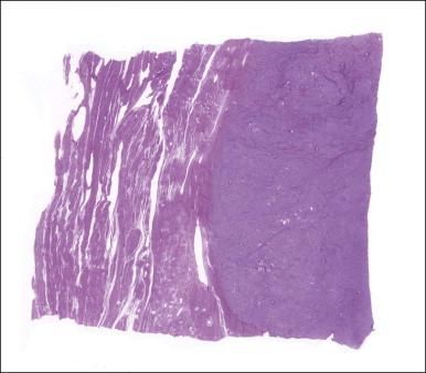 Figure 20.2, Endometrial stromal nodule. A smooth and well-circumscribed border with the surrounding myometrium is characteristic of this tumor.