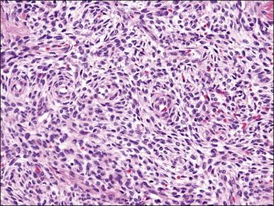 Figure 20.3, Endometrial stromal nodule. The tumor cells are small (‘blue’) with scant cytoplasm and oval to round nuclei that sometimes whorl around arterioles. The microscopic appearance overlaps with that of low-grade endometrial stromal sarcoma.