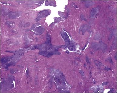 Figure 20.5, Low-grade endometrial stromal sarcoma. The tumor shows a diffuse permeative infiltrative growth.