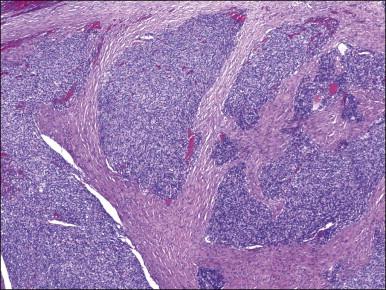 Figure 20.6, Low-grade endometrial stromal sarcoma. The tumor cells form irregular islands that infiltrate the myometrium without an associated desmoplastic response.