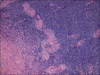 Figure 20.7, Low-grade endometrial stromal sarcoma. Thick blood vessels, most likely entrapped, are seen at the periphery of the tumor islands.