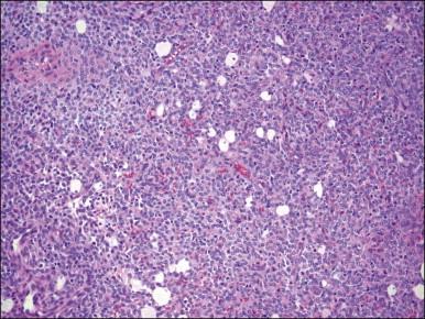 Figure 20.8, Low-grade endometrial stromal sarcoma. Stromal foam cells are interspersed between the neoplastic endometrial stromal cells. They may represent histiocytes, tumor cells, or both.