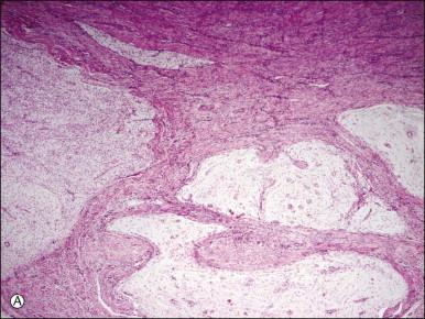 Figure 20.10, Low-grade endometrial stromal sarcoma with myxoid change. The tumor is strikingly hypocellular in contrast to conventional endometrial stromal sarcoma. However, it shows the typical ‘tongue-like’ pattern of infiltration (A) as well as the characteristic arterioles (B) .