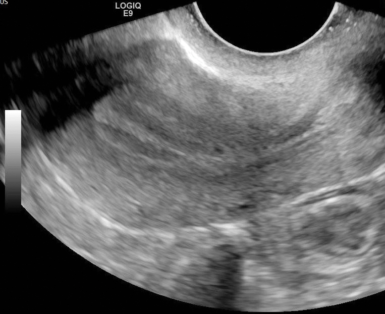 Fig. 31.1, Sagittal view of endovaginal ultrasound examination performed in a 47-year-old woman during the late proliferative phase of her menstrual cycle shows three hyperechoic longitudinal lines separated by the hypoechoic endometrium ( yellow line ), surrounded by the junctional zone appearing as a subendometrial hypoechoic line ( red line ). The white line represents endometrial thickness.