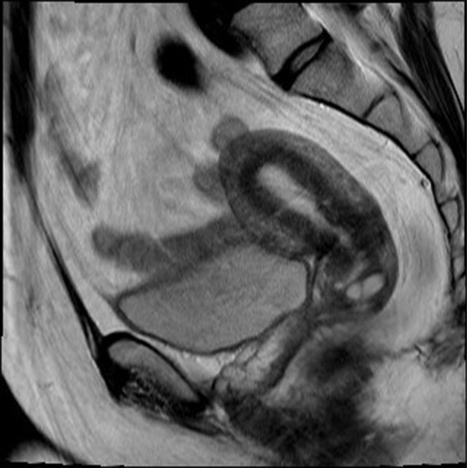 Fig. 31.2, Sagittal T2-weighted magnetic resonance image obtained from a 51-year-old woman shows normal zonal anatomy of the uterus in the anteverted position. The endometrium demonstrates signal intensity slightly higher than that of simple fluid and urine in the bladder ( yellow line ). The outer myometrium demonstrates intermediate signal intensity, whereas the junctional zone ( red line ) shows relatively low signal intensity.