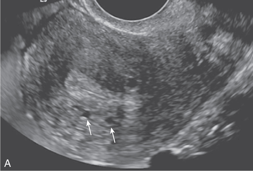 Fig. 31.3, Adenomyosis on ultrasound. On sagittal (A) and transverse (B) images of the uterus, several small myometrial cysts ( arrows ) are seen near the interface with the endometrium, a characteristic finding of adenomyosis. These cysts represent dilated fluid-filled endometrial glands in the myometrium.