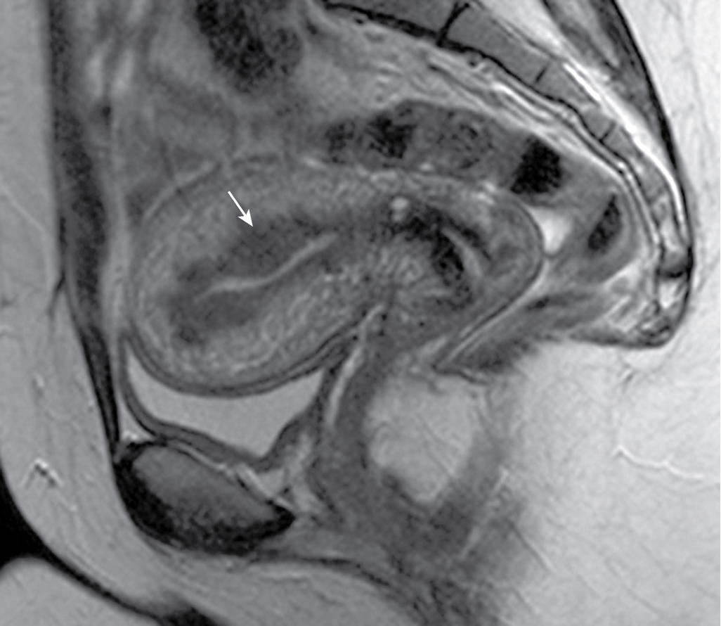 Fig. 31.4, Magnetic resonance imaging of diffuse adenomyosis. The junctional zone ( arrow ) is thickened (>12 mm) on this sagittal T2-weighted image, a finding characteristic of adenomyosis.