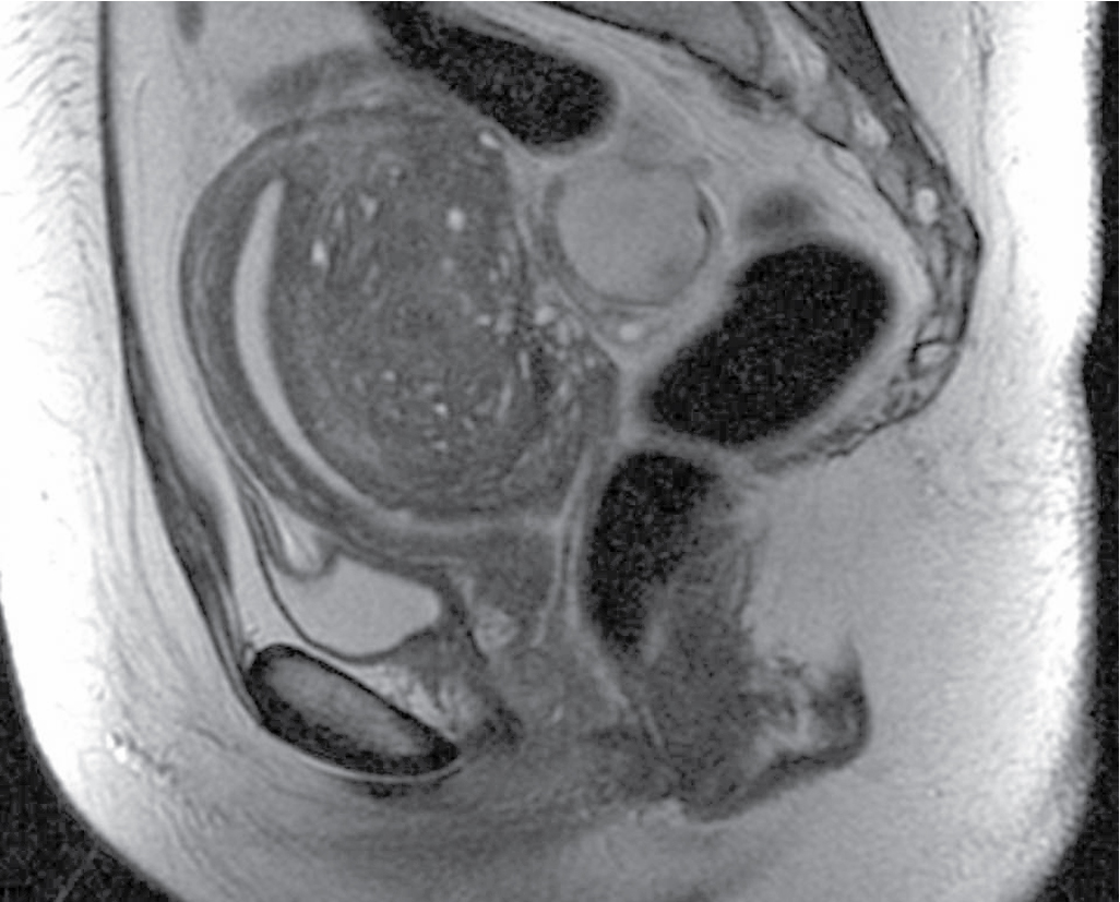 Fig. 31.5, Focal adenomyosis on magnetic resonance imaging. The posterior junctional zone is markedly thickened and contains numerous tiny, hyperintense cystic foci on a sagittal T2-weighted image.