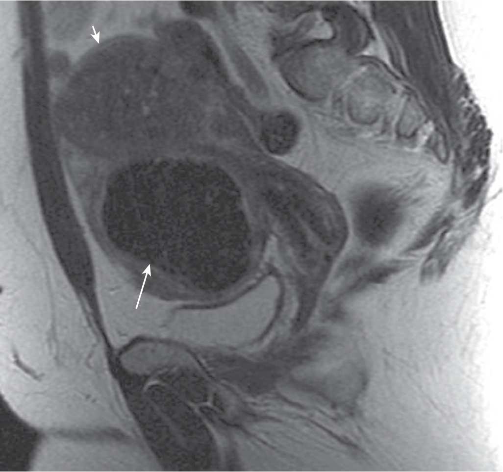 Fig. 31.6, Adenomyoma and fibroid on magnetic resonance imaging (MRI). A mass in the anterior uterine body ( long arrow ) is circumscribed and very low in signal intensity on a sagittal T2-weighted MRI, consistent with a fibroid. A masslike area in the uterine fundus ( short arrow ) is less well defined, less hypointense, and contains several hyperintense cystic foci, compatible with an adenomyoma.