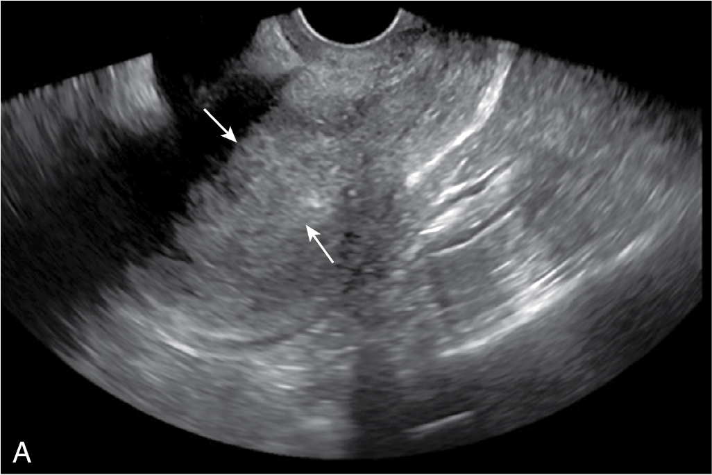 Fig. 31.7, Endometrial thickening in a postmenopausal woman with vaginal bleeding. A and B, Sagittal and transverse ultrasound images show marked thickening of the endometrium ( arrows in A and B). The endometrial echo complex measured 26 mm. Endometrial carcinoma was diagnosed at biopsy.