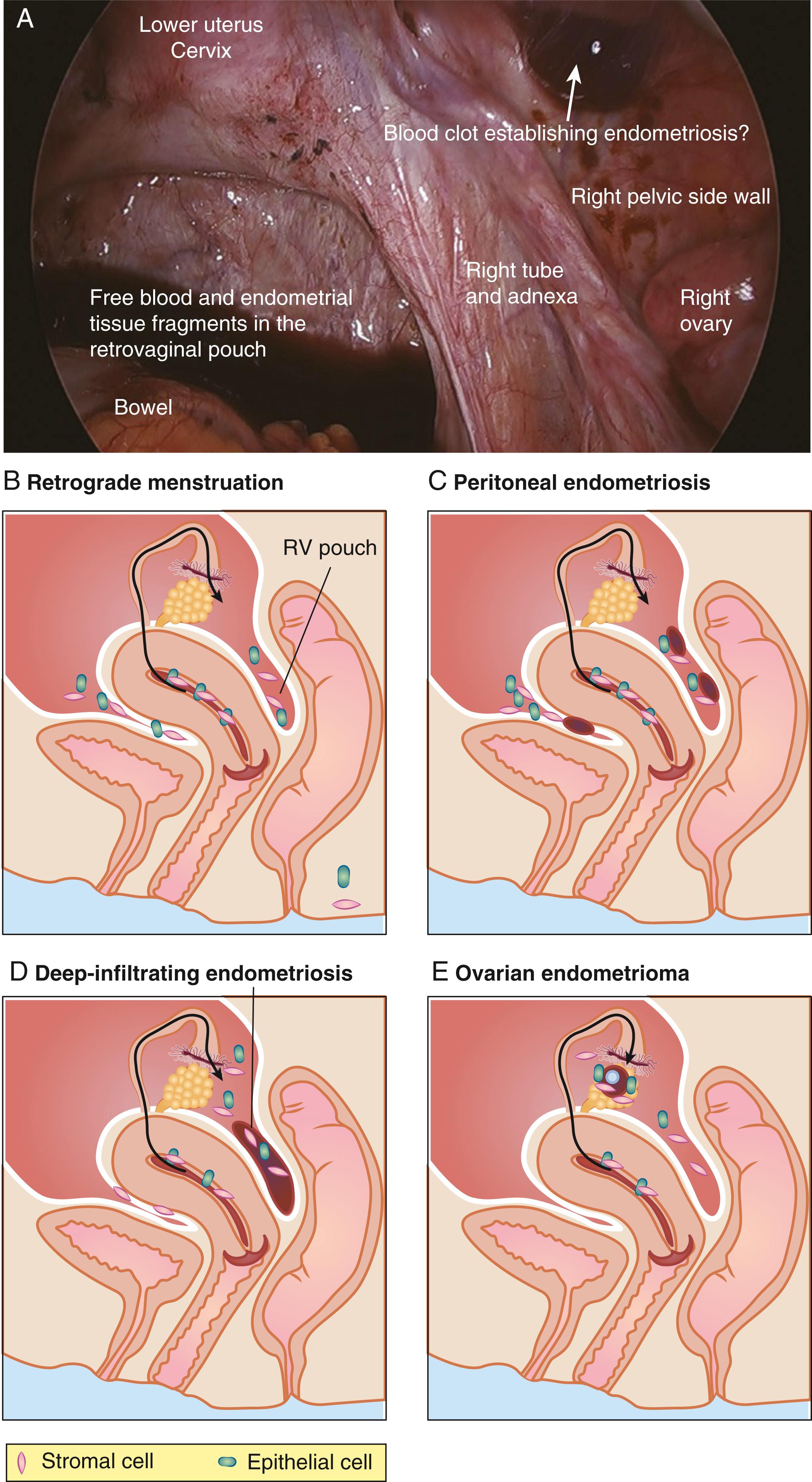 Fig. 27.1, Cellular origins of endometriosis. (A) Collection of bloody menstrual tissue in the cul-de-sac at the time of menses. Pelvic endometriosis occurs primarily as a consequence of cyclic ovulatory menses giving rise to repetitious episodes of retrograde travel of endometrial tissue and blood into the dependent portions of the pelvic cavity. (B) Although retrograde menstruation is observed in the majority of reproductive-age women, endometriosis is encountered only in 10% of these women, suggesting the presence of molecular defects in eutopic endometrial or peritoneal tissues of women with endometriosis. (C) Menstrual cells may survive and grow in peritoneal or subperitoneal locations (peritoneal endometriosis) or (D) get deposited into the cul-de-sac during repetitious episodes of menstruation and remodel the neighboring vaginal, rectal and cervical tissues via a chronic inflammatory process to give rise to a rectovaginal nodule. (E) These cells may also populate the exposed lining of a corpus luteum cyst to eventually evolve into an endometrioma.