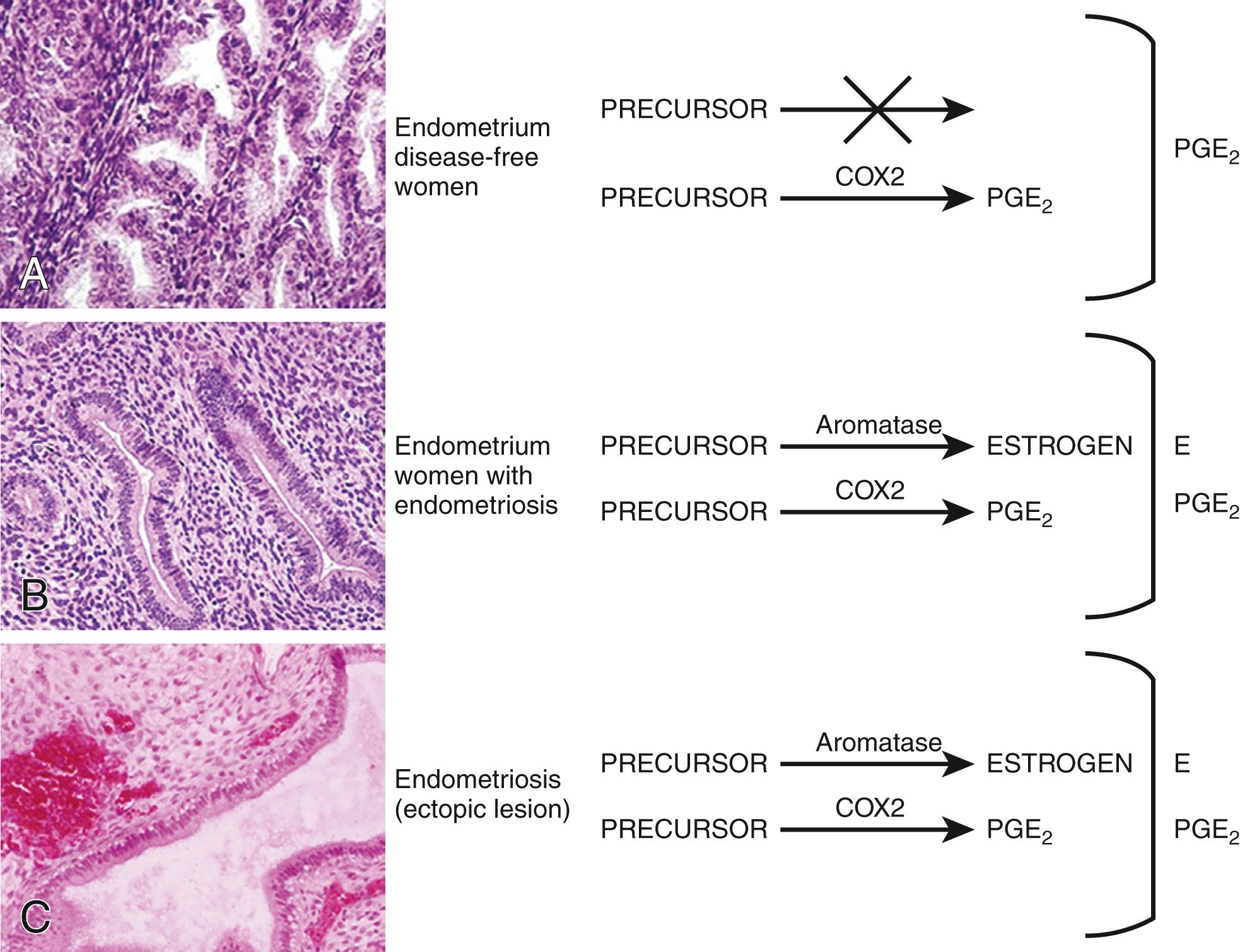 Fig. 27.11, Molecular defects in endometrium and endometriosis.