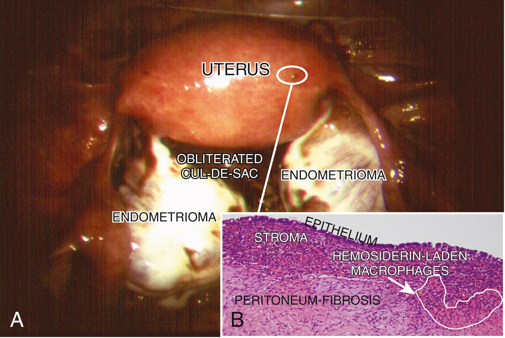 Fig. 27.3, Stage IV endometriosis.