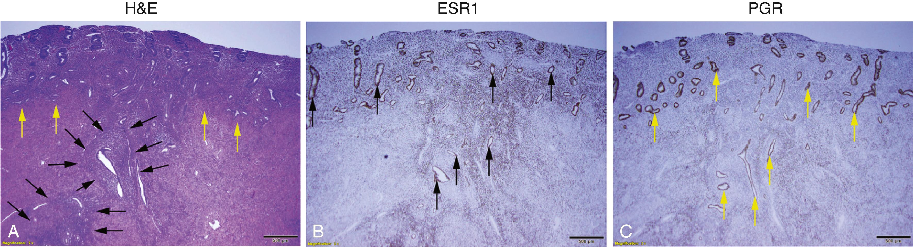 Fig. 27.5, Histopathology of adenomyosis.