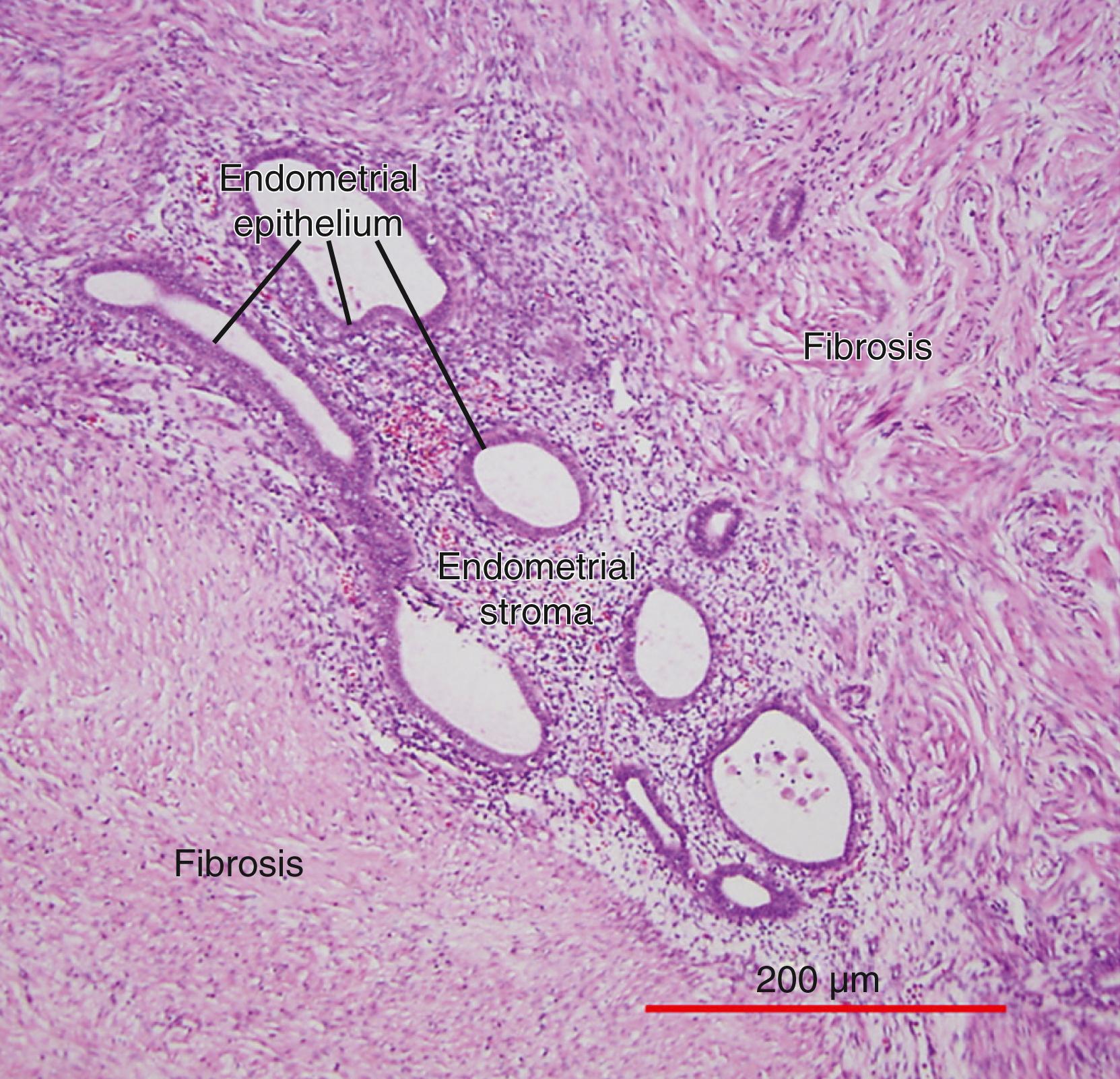 Fig. 27.6, Endometriotic implant buried in fibrotic tissue in pelvic peritoneum.