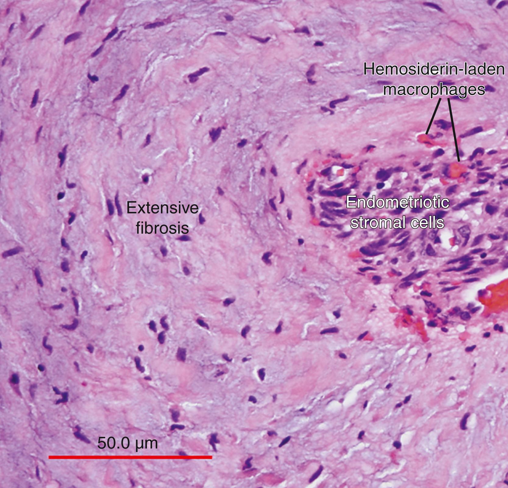 Fig. 27.7, Rectovaginal endometriotic nodule.