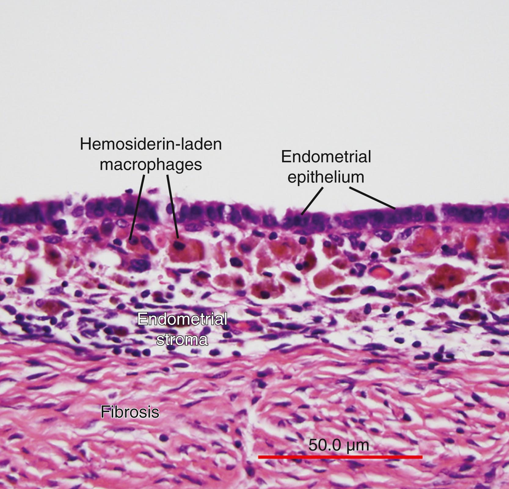 Fig. 27.8, Ovarian endometrioma wall.