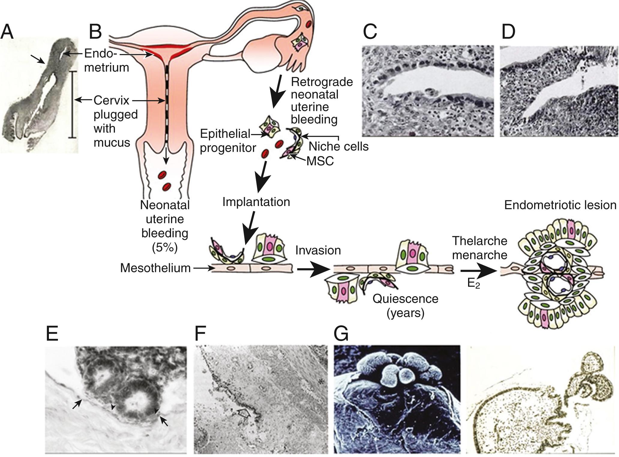 Fig. 27.10, Schematic describing the hypothesis that endometrial stem/progenitor cells may play a role in early-onset endometriosis with supporting images from published works.