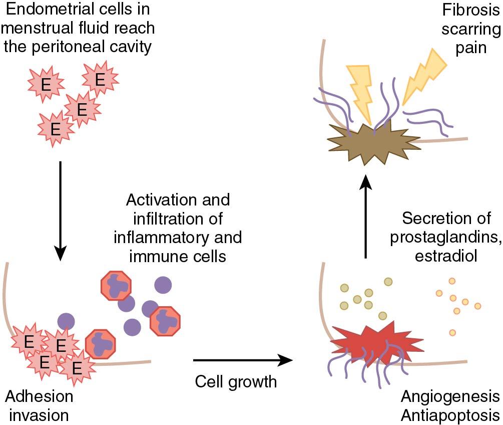 Fig. 19.1, Proposed establishment of peritoneal endometriotic implants via retrograde menstruation, attachment, proliferation, migration, neovascularization, inflammation, and fibrosis. E, Endometrial cell.