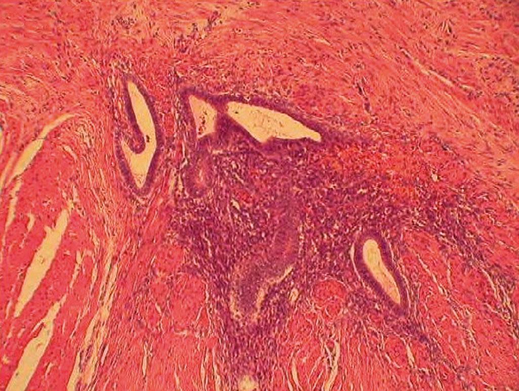 Fig. 19.11, Histologic examination of endometriosis involving the bowel.