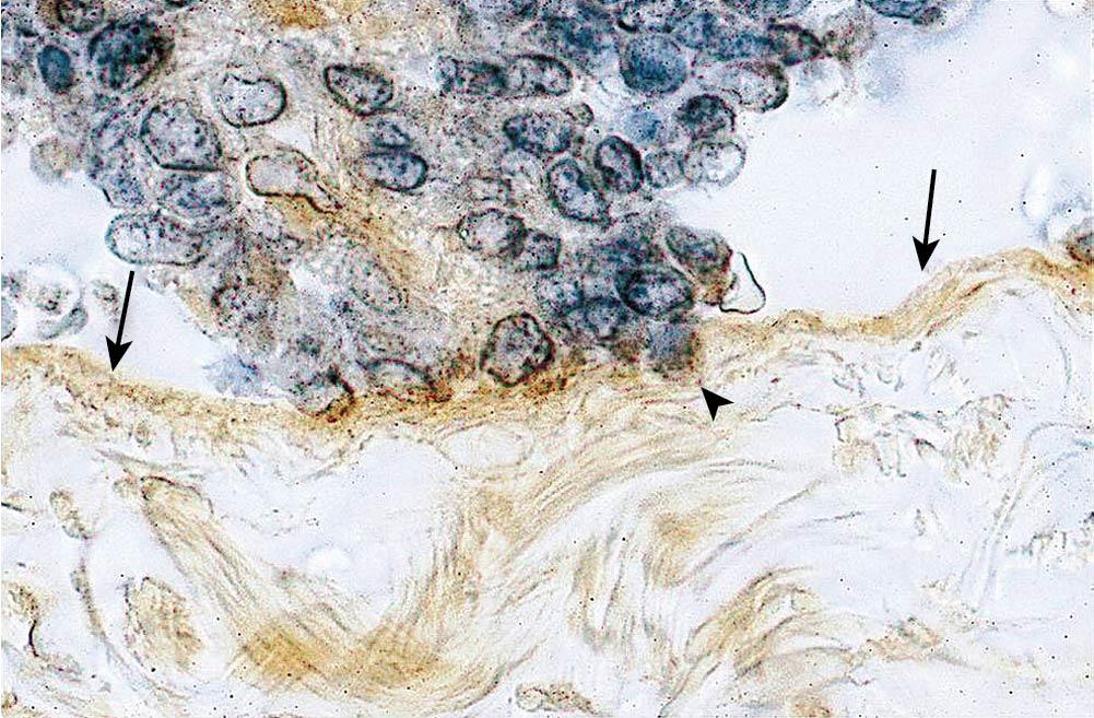 Fig. 19.2, Early invasion of an endometrial implant through the mesothelium. The mesothelium is labeled with monoclonal antibody to cytokeratin and stained with diaminobenzidine (arrows). An endometrial stromal cell (arrowhead) passing through the mesothelium is thought to represent the initial step of invasion into the stroma of the peritoneum. Original magnification, ×31,000. Counterstained with hematoxylin.