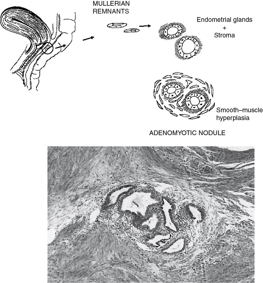 Fig. 19.3, Proposed derivation of endometriotic lesion in the rectovaginal septum.