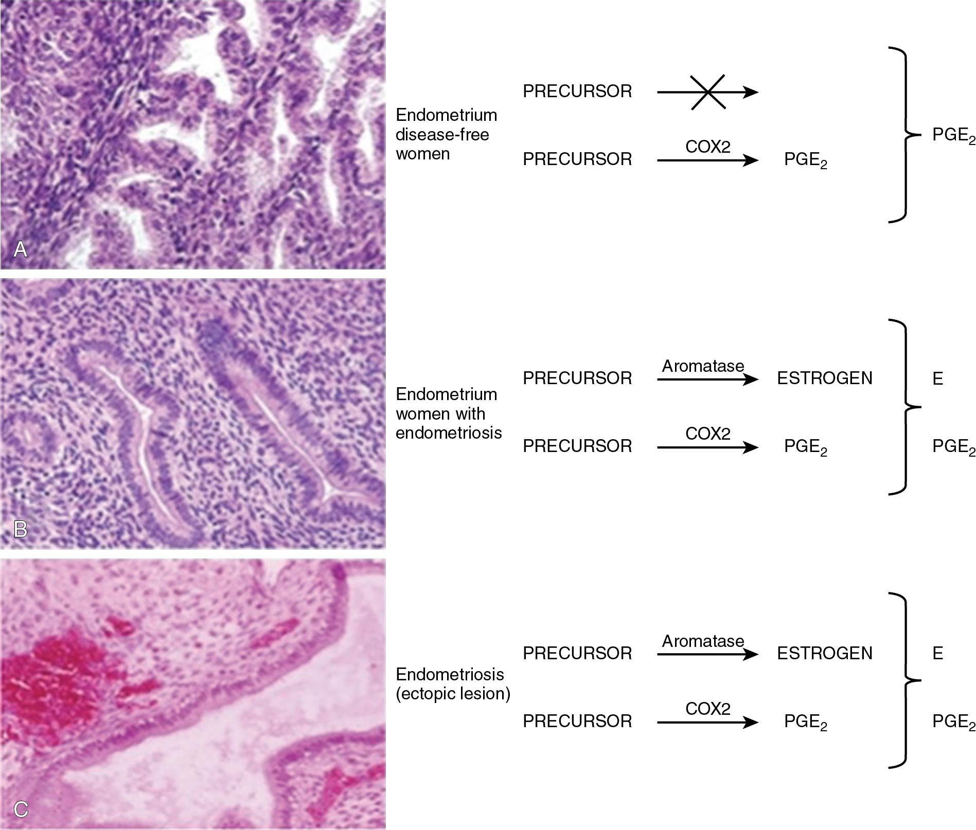 Fig. 19.4, Molecular defects in endometrium and endometriosis. COX2, Cyclooxygenase-2; E, estrogen; PGE 2 , prostaglandin E2;