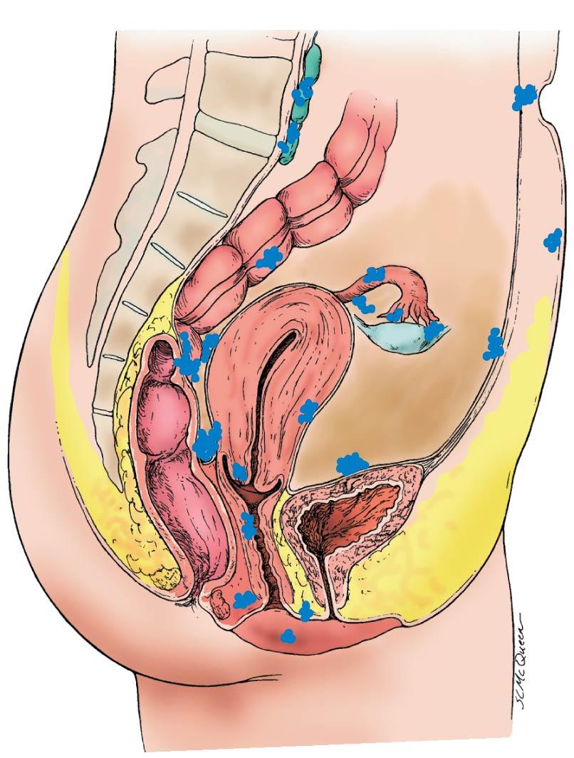 Fig. 19.8, Common pelvic sites of endometriosis.