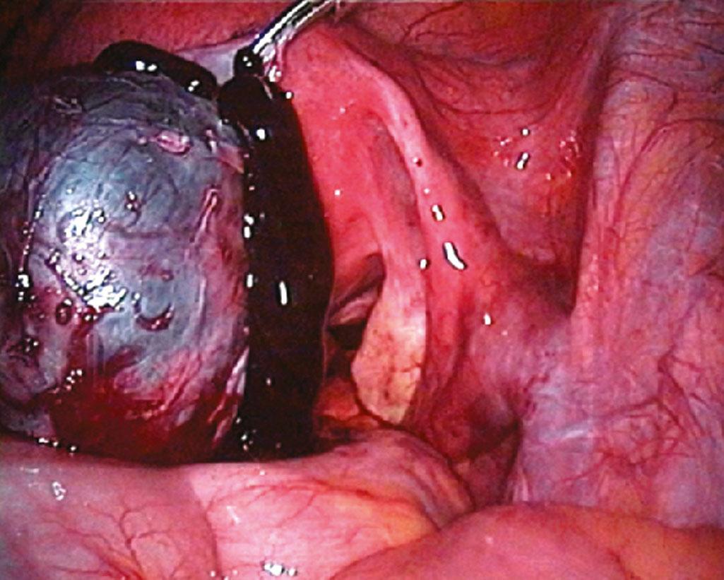 Fig. 19.10, Rupture of large endometrioma “chocolate cyst.”