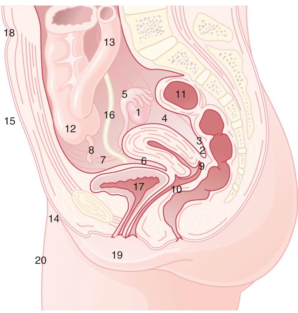 FIGURE 25-1, Common sites of endometriosis in decreasing order of frequency: (1) ovary, (2) cul-de-sac, (3) uterosacral ligaments, (4) broad ligaments, (5) fallopian tubes, (6) uterovesical fold, (7) round ligaments, (8) vermiform appendix, (9) vagina, (10) rectovaginal septum, (11) rectosigmoid colon, (12) cecum, (13) ileum, (14) inguinal canals, (15) abdominal scars, (16) ureters, (17) urinary bladder, (18) umbilicus, (19) vulva, and (20) peripheral sites.