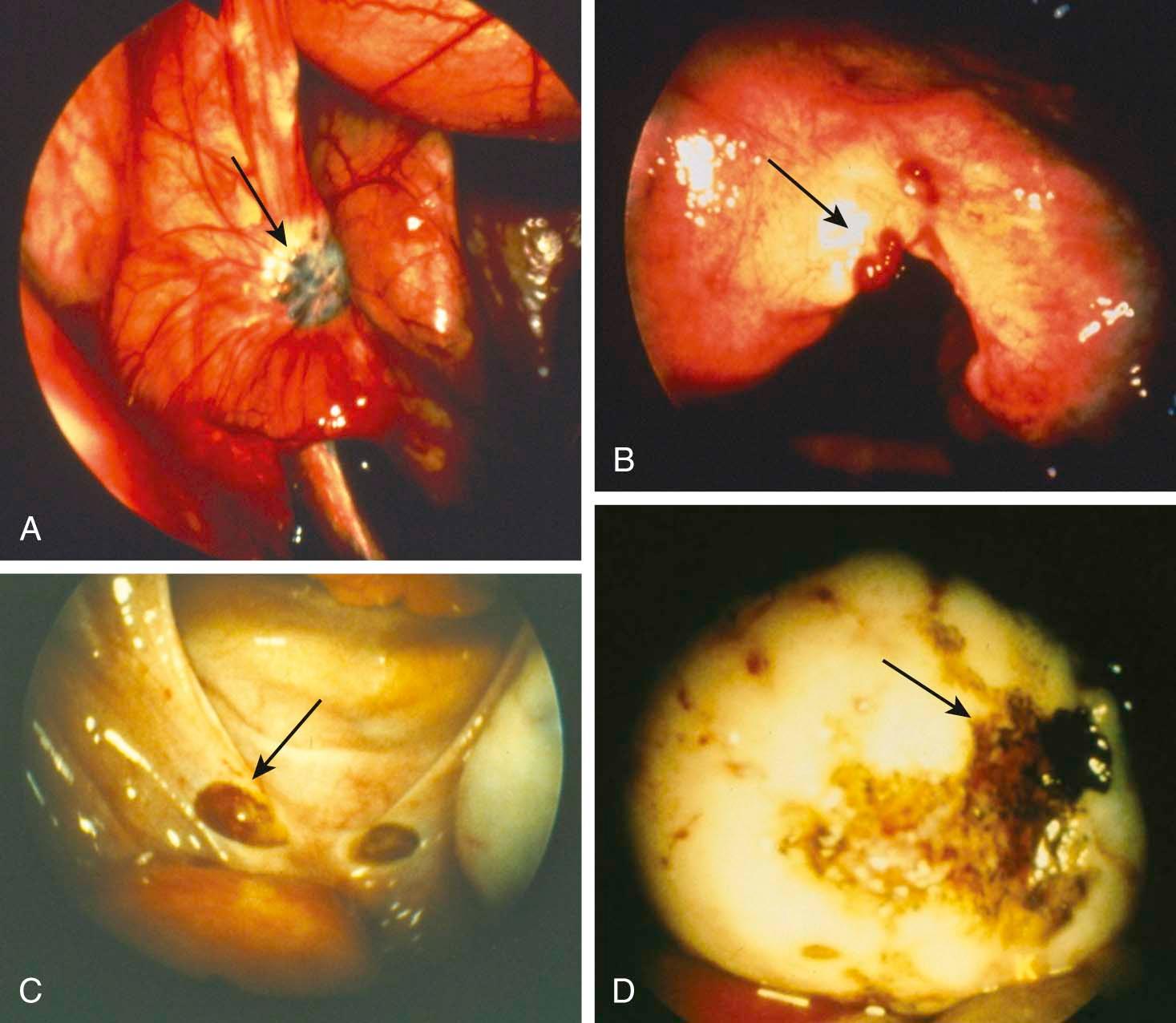 FIGURE 25-2, Appearance of red (B), brown (C), and black (D) raised lesions (arrows) of active endometriosis at the time of laparoscopy. The common finding of blue-gray lesions (A) represents less active “tatooing” of old endometriosis.