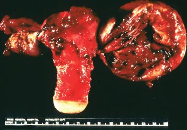 Fig. 19.1, Ovarian endometriotic cyst. The cyst has been opened to reveal contents of old blood. Foci of endometriosis are also seen on the uterine serosa and the opposite ovary.