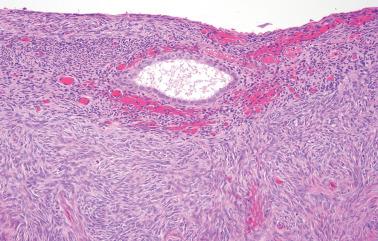 Fig. 19.11, Endometriosis involving ovarian surface. A plaque like proliferation is seen with a central endometriotic gland and cuff of stromal cells that also extend laterally.