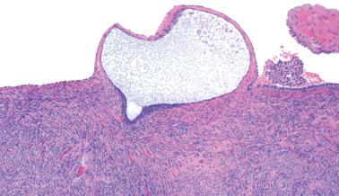 Fig. 19.13, Endometriosis involving the ovarian surface. This atrophic gland projects from the surface in a manner commonly seen. A hint of endometrial stroma is seen around an outpouching at the bottom left of the gland.