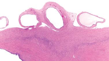 Fig. 19.14, Endometriosis involving the ovarian surface. Three cystically dilated glands with atrophic stroma project from the ovarian surface.