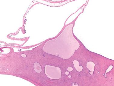 Fig. 19.15, Endometriosis with adjacent early adenofibroma development. Cystic atrophic endometriosis (top) merges with glands associated with prominent fibromatous stroma.