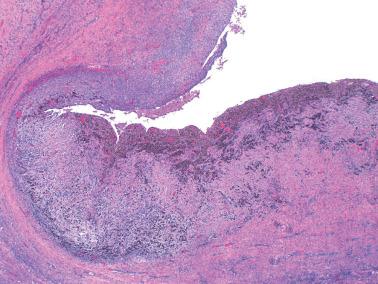 Fig. 19.16, Ovarian endometriotic cyst. The cyst wall has abundant hemorrhage and fibrosis.