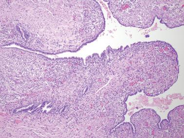 Fig. 19.17, Ovarian endometriotic cyst. The stroma in this case contains numerous pseudoxanthoma cells.