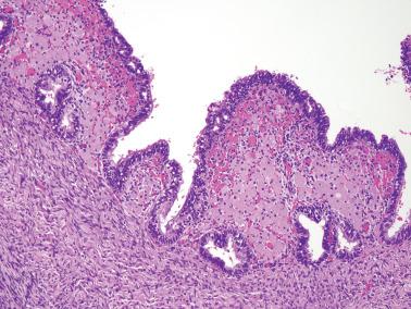 Fig. 19.18, Ovarian endometriotic cyst. Pseudoxanthoma cells, as seen in the prior illustration, are again present with their typical abundant light brown cytoplasm.