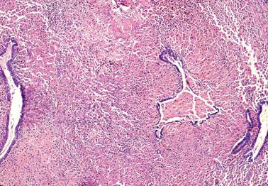 Fig. 19.19, Endometriosis. The endometriotic glands are separated by sheets of pseudoxanthoma cells.