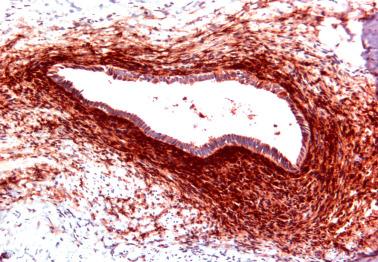 Fig. 19.20, Endometriosis. The periglandular stroma is immunoreactive for CD10.