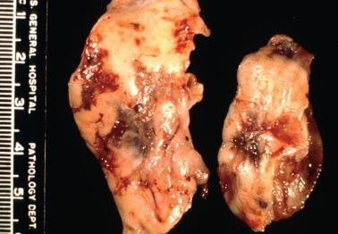 Fig. 19.2, Ovarian endometriosis. The serosal surfaces of both ovaries are involved by multiple hemorrhagic and brown to black pigmented lesions, some of which are retracted.